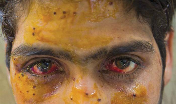 Pellet victims under life risk threat in IOK: Expert