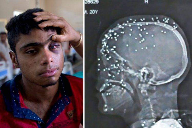 Indian Army pellets use against Kashmiris have made permanent blindness: Doctors  