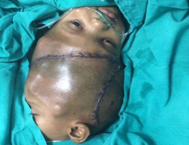 Indian surgeons separate twin boys with conjoined heads