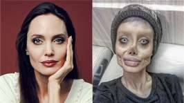 It took 50 surgeries for Iranian girl to become Angelina Julie but here she is