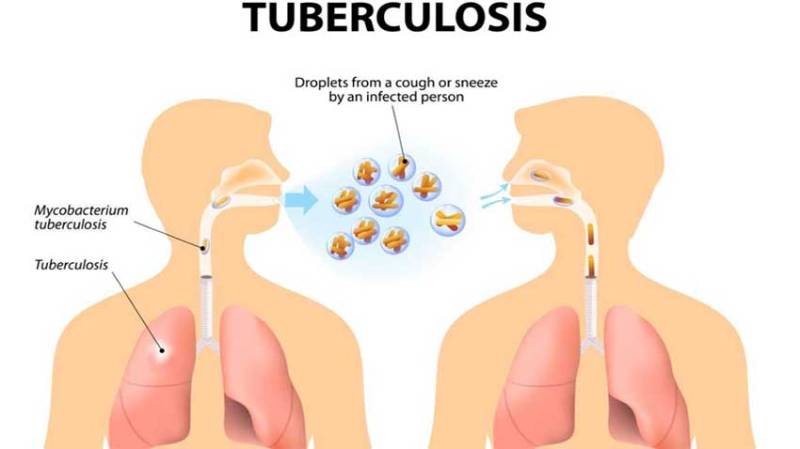 KP govt to launch 2nd phase of special program to eradicate tuberculosis