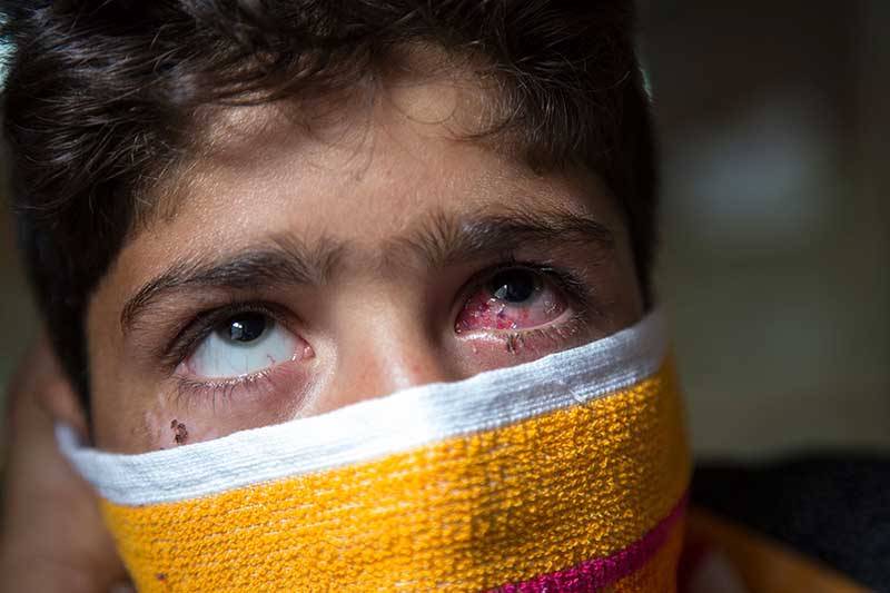 In occupied Kashmir, most victims of Pellet guns suffer visual impairment of various degrees: Study