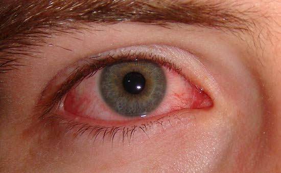 Punjab Health authority issues alert as eye infection afflicts thousands